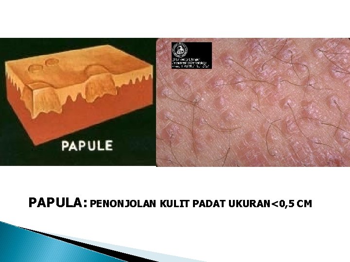 PAPULA: PENONJOLAN KULIT PADAT UKURAN<0, 5 CM PAPULA: PENONJOLAN KULIT PADAT UKURAN<0, 5 CM