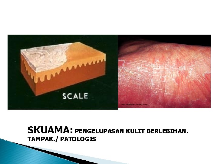 SKUAMA: PENGELUPASAN KULIT BERLEBIHAN. TAMPAK. / PATOLOGIS SKUAMA: PENGELUPASAN KULIT BERLEBIHAN. TAMPAK. / PATOLOGIS