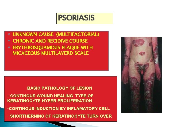 PSORIASIS UNKNOWN CAUSE (MULTIFACTORIAL) CHRONIC AND RECIDIVE COURSE ERYTHROSQUAMOUS PLAQUE WITH MICACEOUS MULTILAYERD SCALE PSORIASIS UNKNOWN CAUSE (MULTIFACTORIAL) CHRONIC AND RECIDIVE COURSE ERYTHROSQUAMOUS PLAQUE WITH MICACEOUS MULTILAYERD SCALE