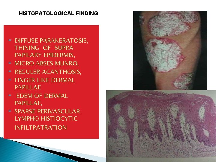 HISTOPATOLOGICAL FINDING DIFFUSE PARAKERATOSIS, THINING OF SUPRA PAPILARY EPIDERMIS, MICRO ABSES MUNRO, REGULER ACANTHOSIS, HISTOPATOLOGICAL FINDING DIFFUSE PARAKERATOSIS, THINING OF SUPRA PAPILARY EPIDERMIS, MICRO ABSES MUNRO, REGULER ACANTHOSIS,