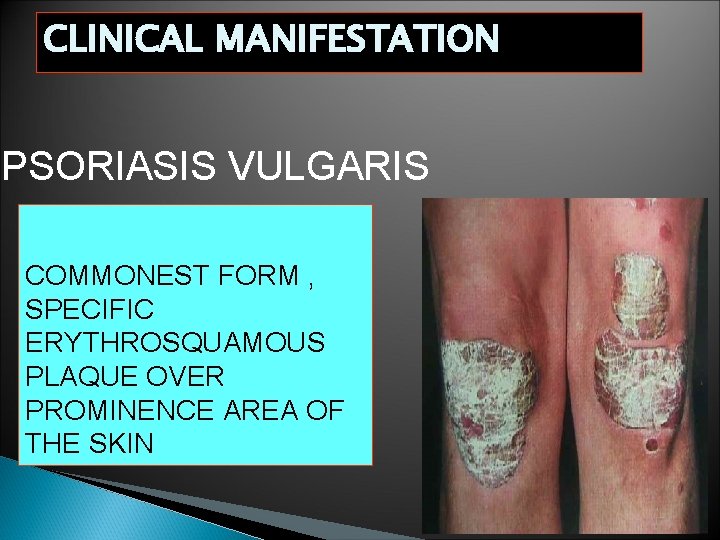 CLINICAL MANIFESTATION PSORIASIS VULGARIS COMMONEST FORM , SPECIFIC ERYTHROSQUAMOUS PLAQUE OVER PROMINENCE AREA OF CLINICAL MANIFESTATION PSORIASIS VULGARIS COMMONEST FORM , SPECIFIC ERYTHROSQUAMOUS PLAQUE OVER PROMINENCE AREA OF