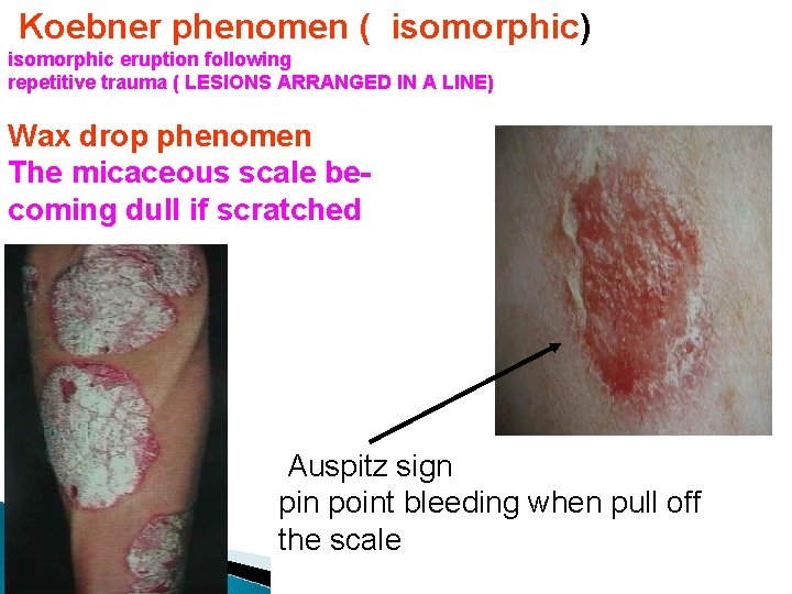 Koebner phenomen ( isomorphic) isomorphic eruption following repetitive trauma ( LESIONS ARRANGED IN A Koebner phenomen ( isomorphic) isomorphic eruption following repetitive trauma ( LESIONS ARRANGED IN A