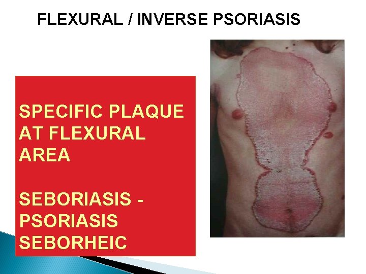 FLEXURAL / INVERSE PSORIASIS SPECIFIC PLAQUE AT FLEXURAL AREA SEBORIASIS PSORIASIS SEBORHEIC FLEXURAL / INVERSE PSORIASIS SPECIFIC PLAQUE AT FLEXURAL AREA SEBORIASIS PSORIASIS SEBORHEIC