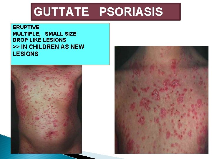 GUTTATE PSORIASIS ERUPTIVE MULTIPLE, SMALL SIZE DROP LIKE LESIONS >> IN CHILDREN AS NEW GUTTATE PSORIASIS ERUPTIVE MULTIPLE, SMALL SIZE DROP LIKE LESIONS >> IN CHILDREN AS NEW