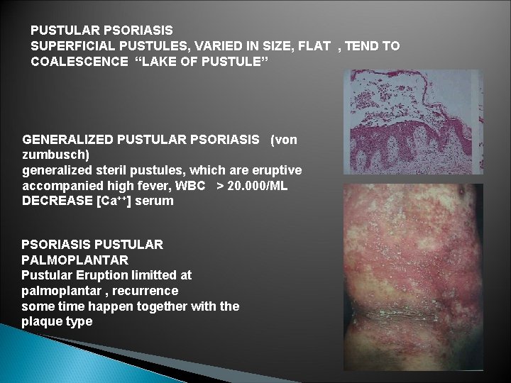 PUSTULAR PSORIASIS SUPERFICIAL PUSTULES, VARIED IN SIZE, FLAT , TEND TO COALESCENCE “LAKE OF PUSTULAR PSORIASIS SUPERFICIAL PUSTULES, VARIED IN SIZE, FLAT , TEND TO COALESCENCE “LAKE OF