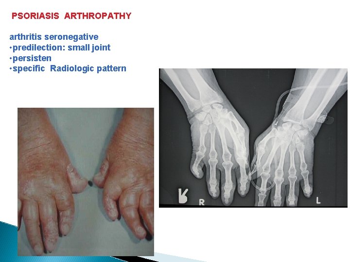 PSORIASIS ARTHROPATHY arthritis seronegative • predilection: small joint • persisten • specific Radiologic pattern PSORIASIS ARTHROPATHY arthritis seronegative • predilection: small joint • persisten • specific Radiologic pattern