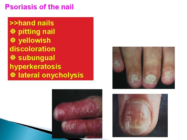 Psoriasis of the nail >>hand nails ] pitting nail ] yellowish discoloration ] subungual