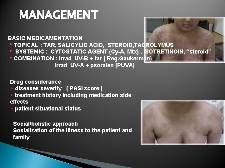 MANAGEMENT BASIC MEDICAMENTATION h. TOPICAL : TAR, SALICYLIC ACID, STEROID, TACROLYMUS h SYSTEMIC : MANAGEMENT BASIC MEDICAMENTATION h. TOPICAL : TAR, SALICYLIC ACID, STEROID, TACROLYMUS h SYSTEMIC :