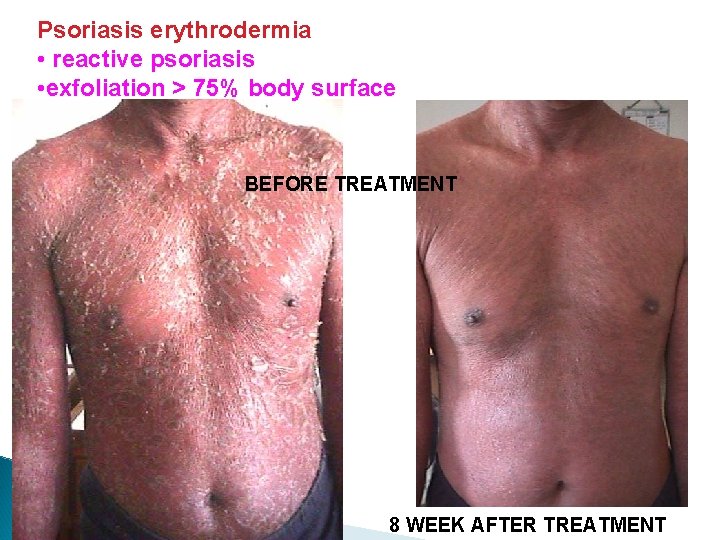 Psoriasis erythrodermia • reactive psoriasis • exfoliation > 75% body surface BEFORE TREATMENT 8 Psoriasis erythrodermia • reactive psoriasis • exfoliation > 75% body surface BEFORE TREATMENT 8