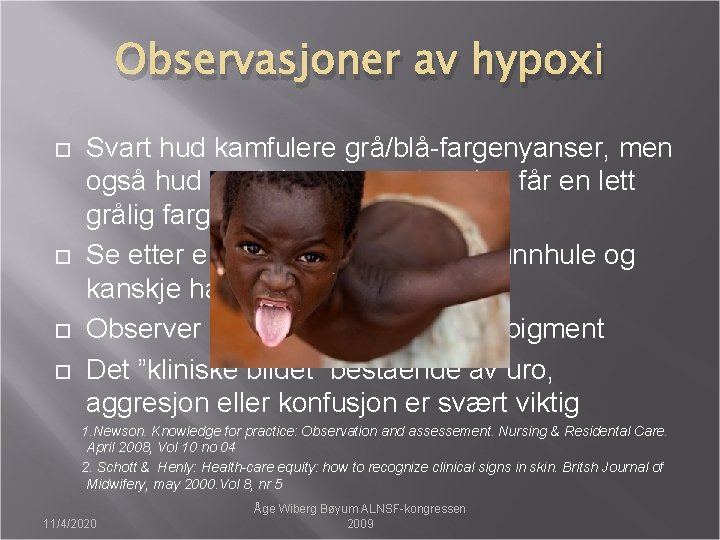 Observasjoner av hypoxi Svart hud kamfulere grå/blå-fargenyanser, men også hud med dyp pigmenterering får