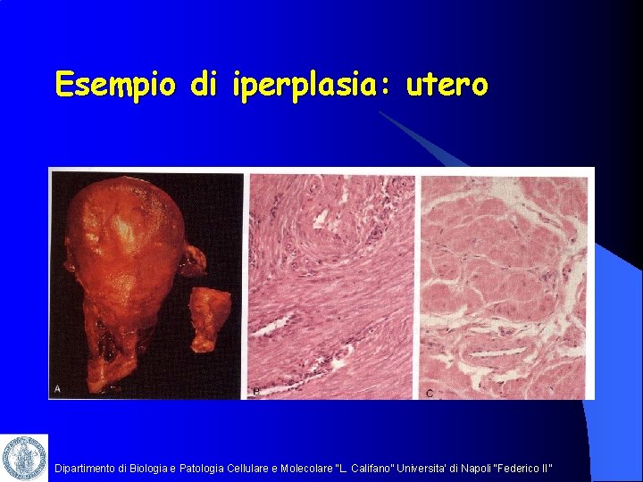 Esempio di iperplasia: utero Dipartimento di Biologia e Patologia Cellulare e Molecolare “L. Califano”