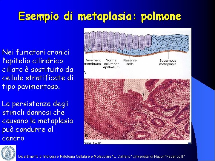 Esempio di metaplasia: polmone Nei fumatori cronici l’epitelio cilindrico ciliato è sostituito da cellule