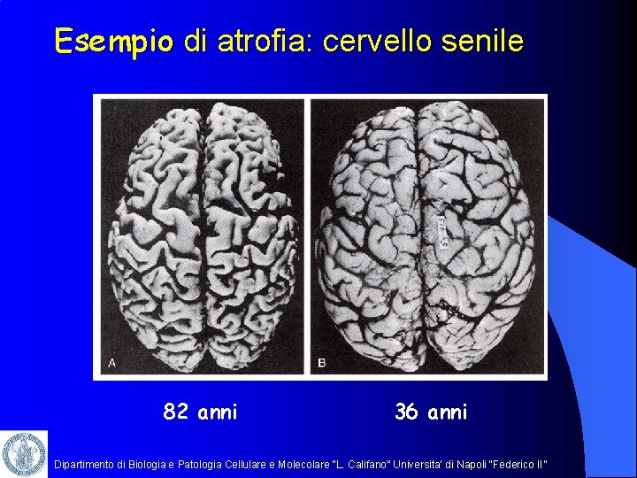 Esempio di atrofia: cervello senile 82 anni 36 anni Dipartimento di Biologia e Patologia