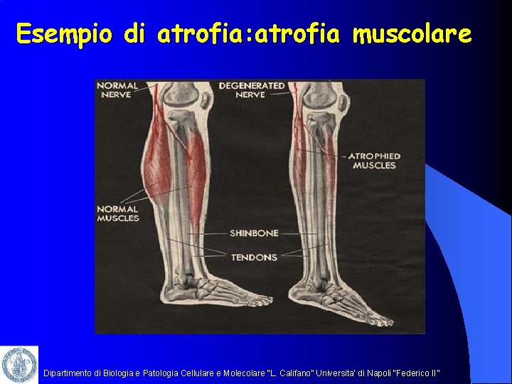 Esempio di atrofia: atrofia muscolare Dipartimento di Biologia e Patologia Cellulare e Molecolare “L.