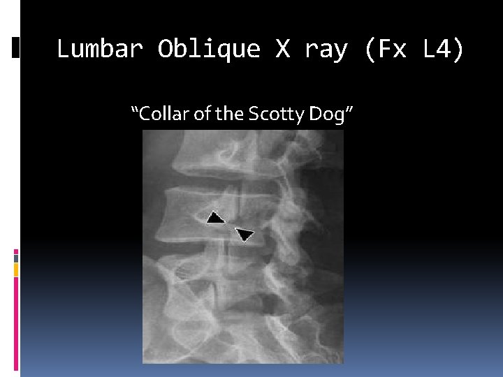 Lumbar Oblique X ray (Fx L 4) “Collar of the Scotty Dog” 