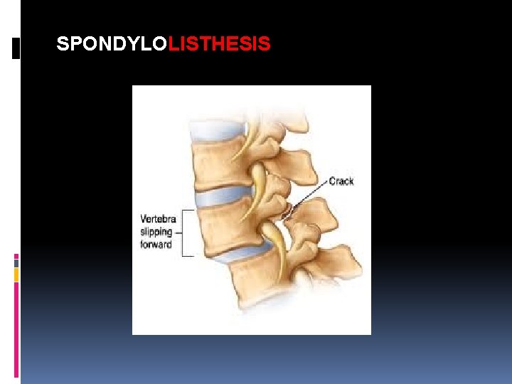 SPONDYLOLISTHESIS 