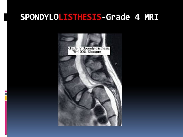 SPONDYLOLISTHESIS-Grade 4 MRI 