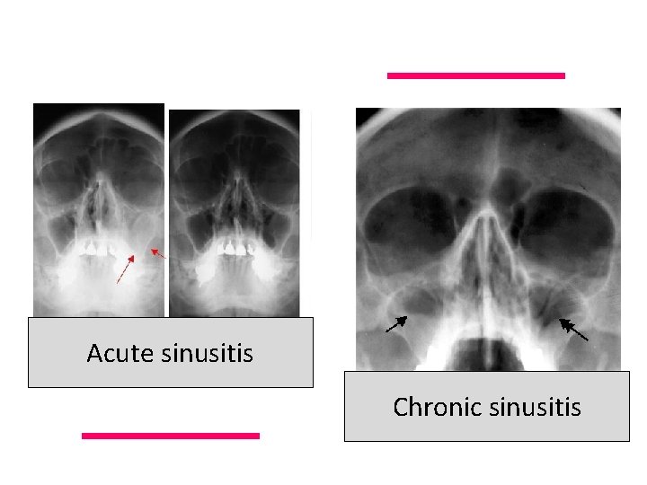 Acute sinusitis Chronic sinusitis 