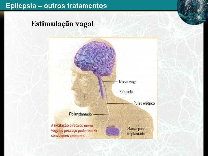 Epilepsia – outros tratamentos - Estimulação vagal 