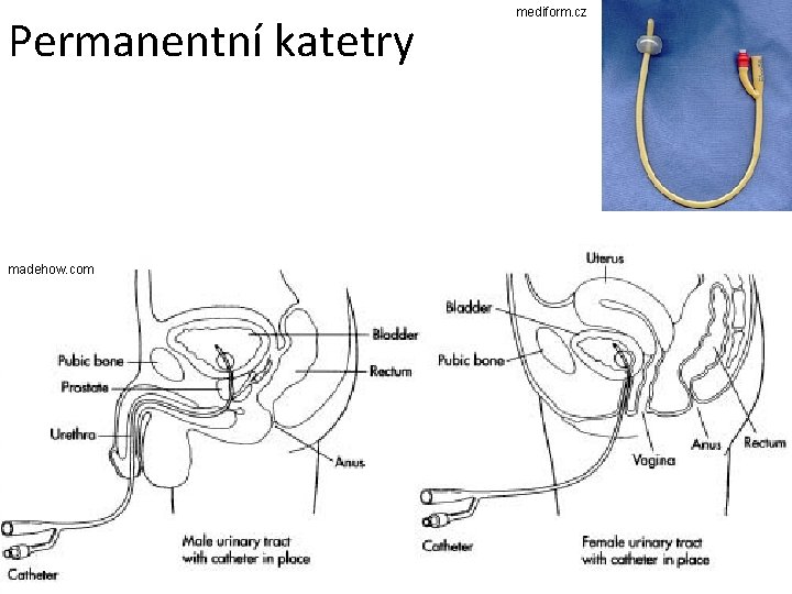 Permanentní katetry madehow. com mediform. cz 