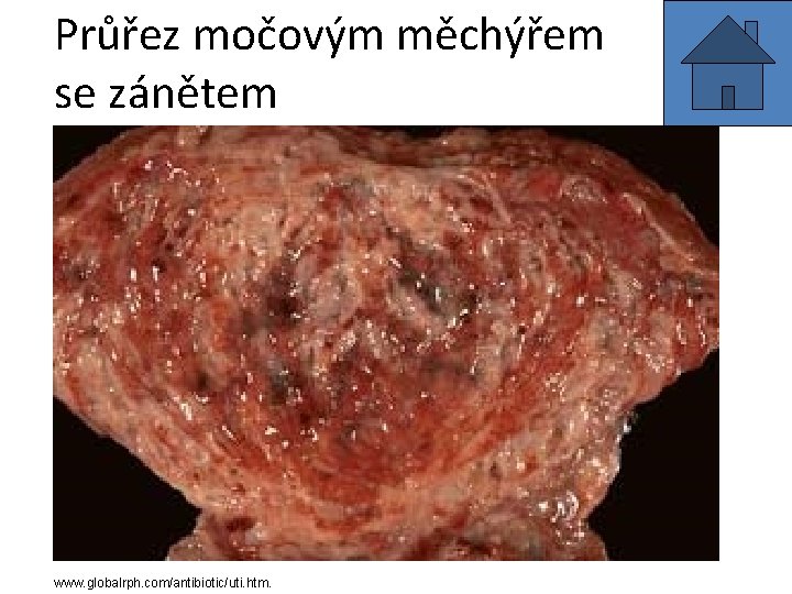 Průřez močovým měchýřem se zánětem www. globalrph. com/antibiotic/uti. htm. 