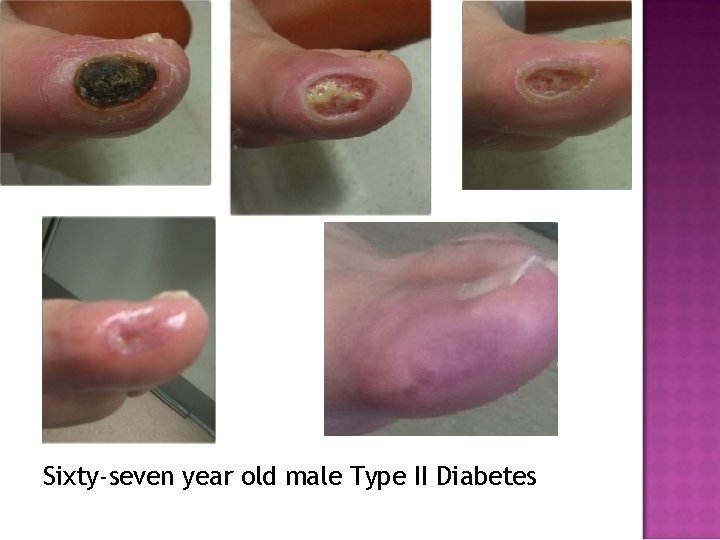 Sixty-seven year old male Type II Diabetes 