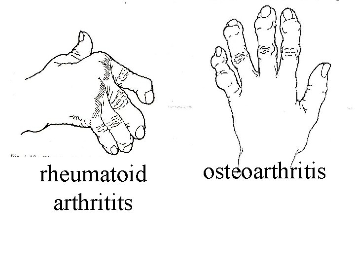 Arthritis • rheumatoid arthritits osteoarthritis 