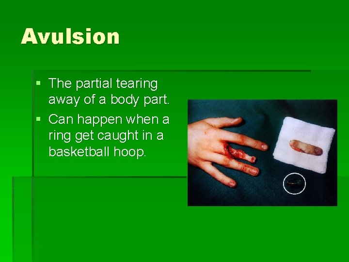 Avulsion § The partial tearing away of a body part. § Can happen when