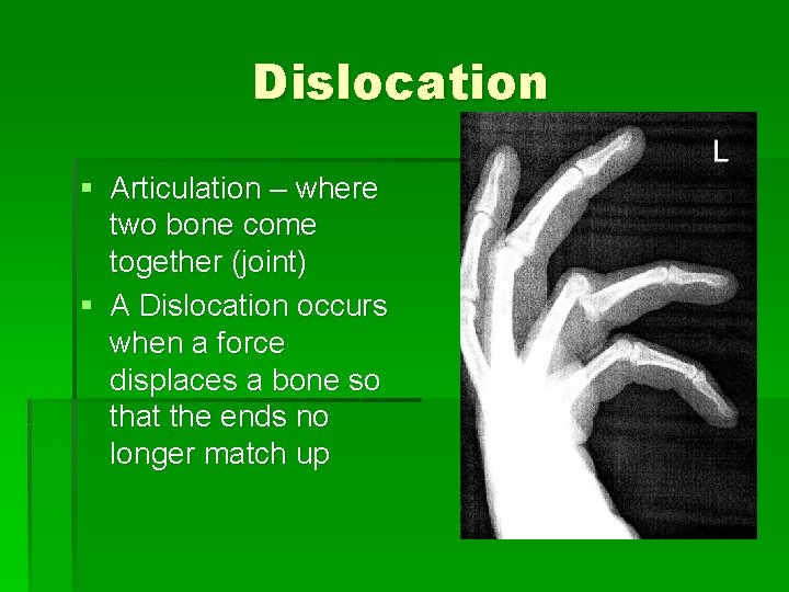 Dislocation § Articulation – where two bone come together (joint) § A Dislocation occurs