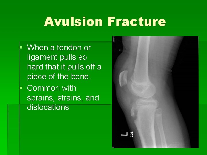 Avulsion Fracture § When a tendon or ligament pulls so hard that it pulls