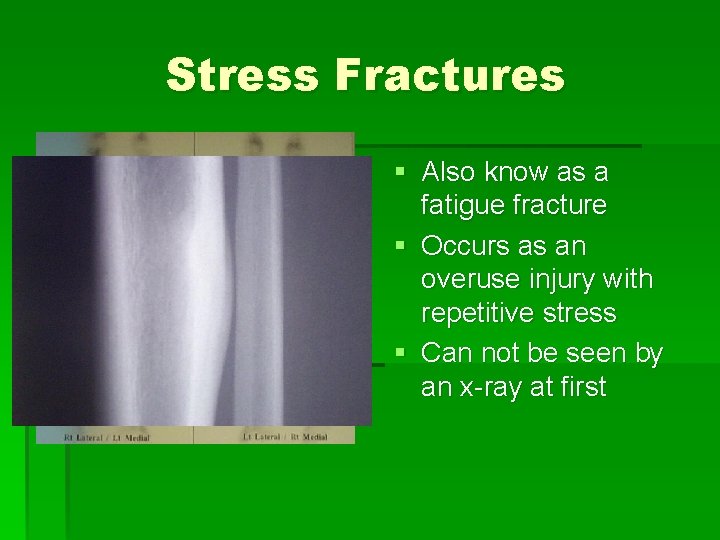 Stress Fractures § Also know as a fatigue fracture § Occurs as an overuse