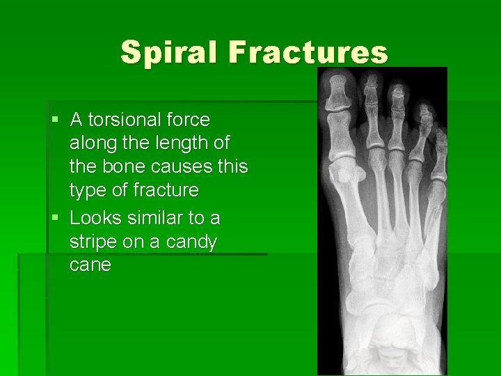 Spiral Fractures § A torsional force along the length of the bone causes this