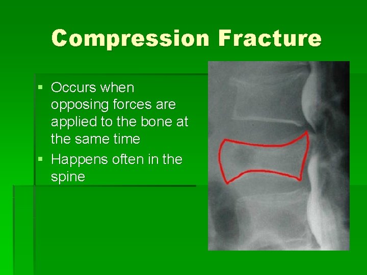 Compression Fracture § Occurs when opposing forces are applied to the bone at the