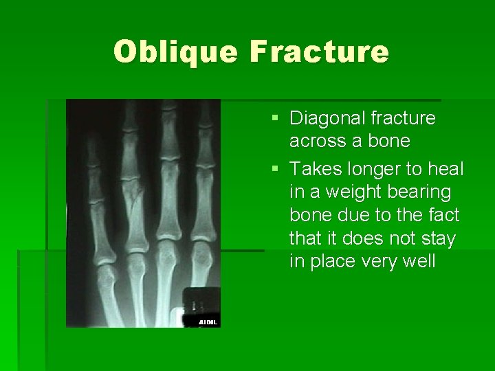 Oblique Fracture § Diagonal fracture across a bone § Takes longer to heal in