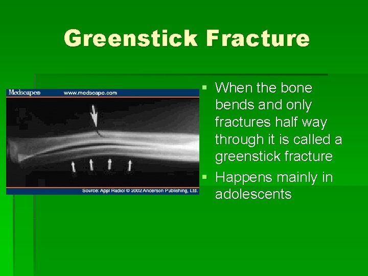 Greenstick Fracture § When the bone bends and only fractures half way through it