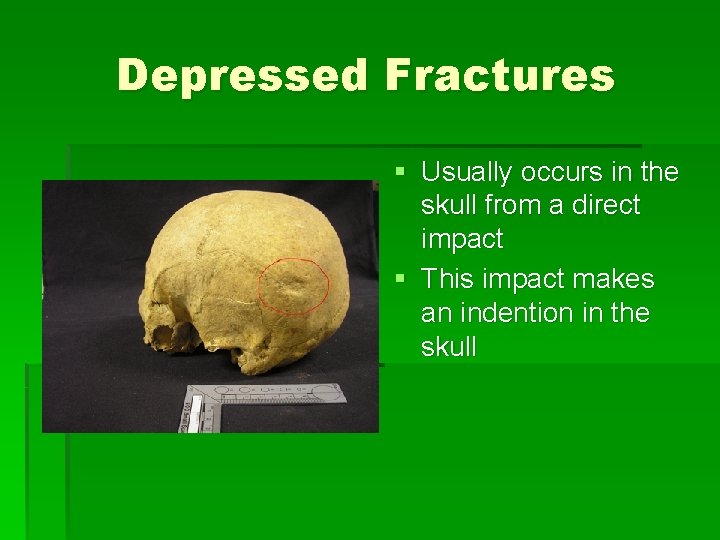 Depressed Fractures § Usually occurs in the skull from a direct impact § This