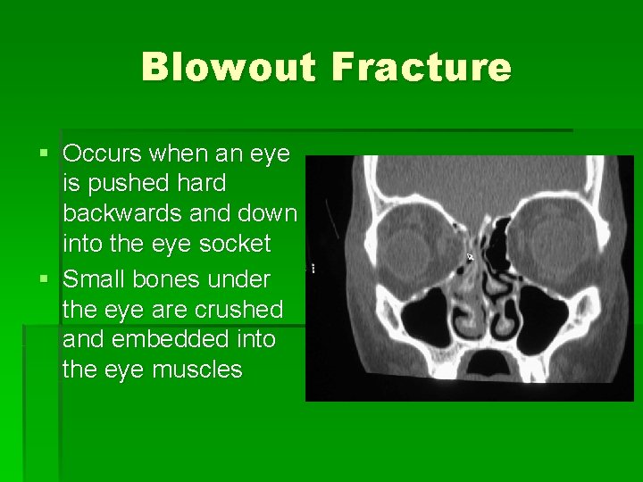 Blowout Fracture § Occurs when an eye is pushed hard backwards and down into