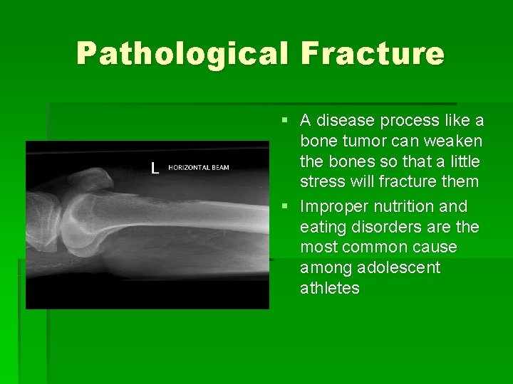 Pathological Fracture § A disease process like a bone tumor can weaken the bones