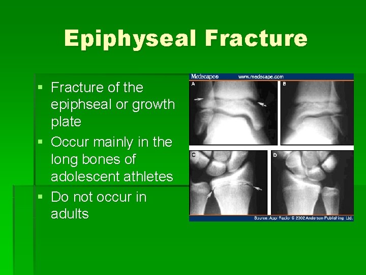 Epiphyseal Fracture § Fracture of the epiphseal or growth plate § Occur mainly in