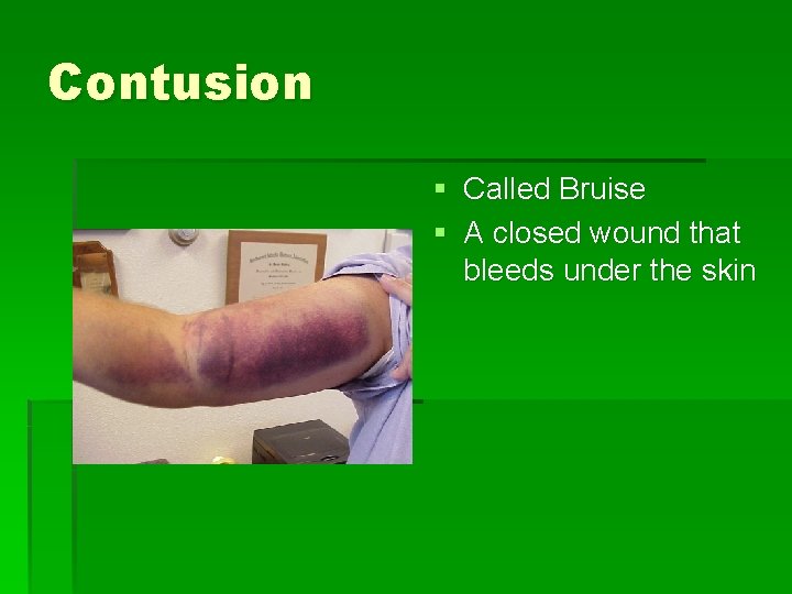 Contusion § Called Bruise § A closed wound that bleeds under the skin 