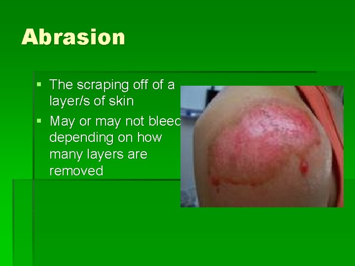 Abrasion § The scraping off of a layer/s of skin § May or may