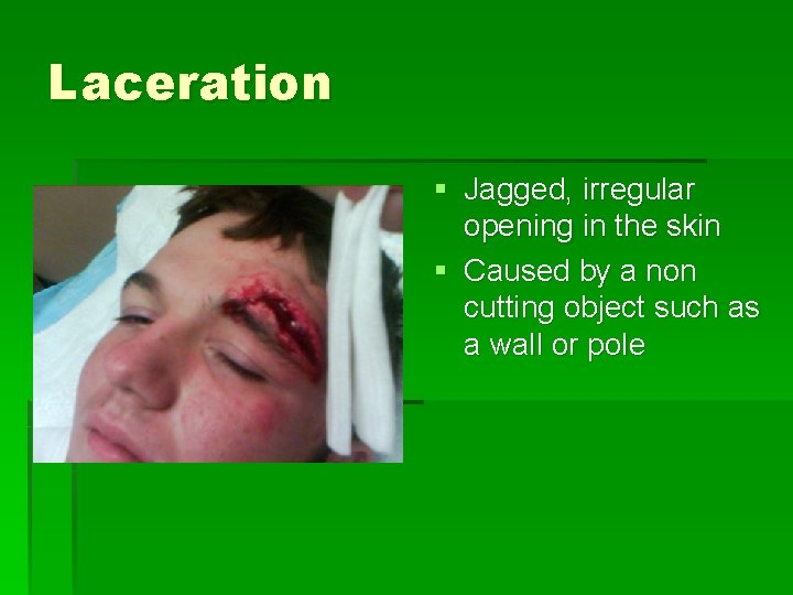 Laceration § Jagged, irregular opening in the skin § Caused by a non cutting