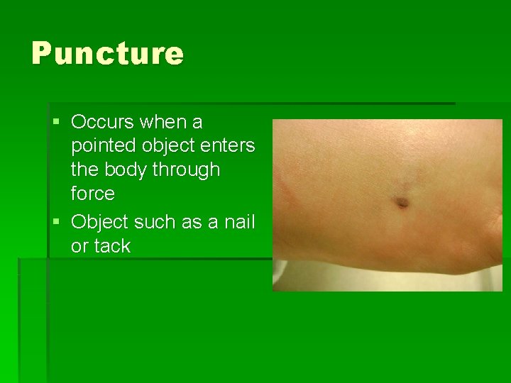 Puncture § Occurs when a pointed object enters the body through force § Object