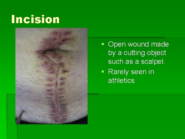 Incision § Open wound made by a cutting object such as a scalpel. §