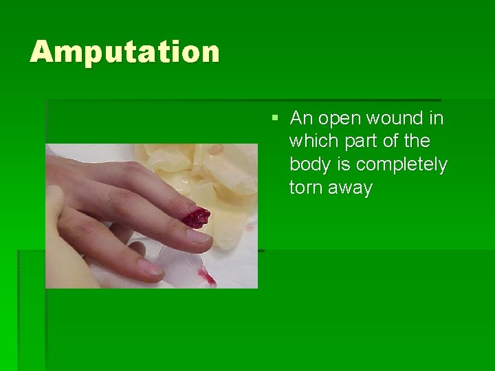 Amputation § An open wound in which part of the body is completely torn