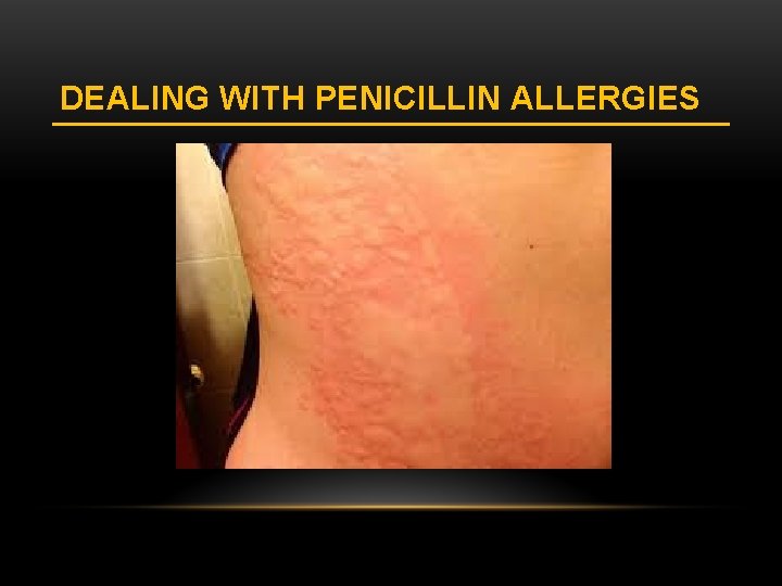 DEALING WITH PENICILLIN ALLERGIES 