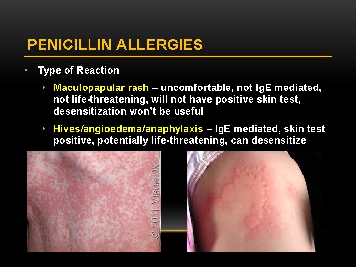 PENICILLIN ALLERGIES • Type of Reaction • Maculopapular rash – uncomfortable, not Ig. E