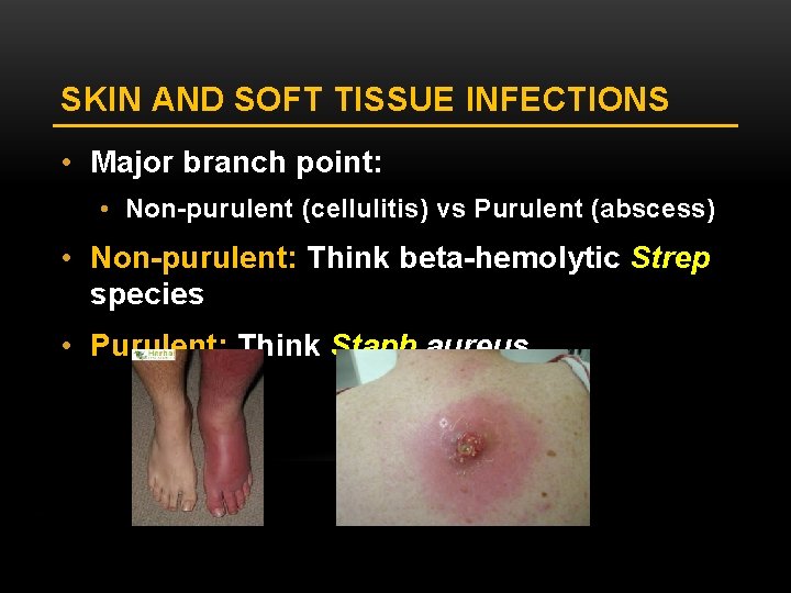 SKIN AND SOFT TISSUE INFECTIONS • Major branch point: • Non-purulent (cellulitis) vs Purulent