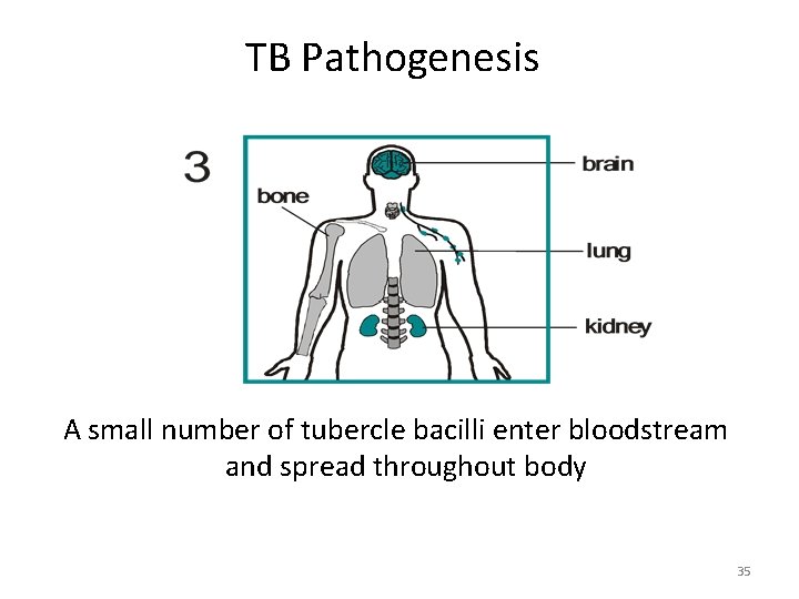 TB Pathogenesis A small number of tubercle bacilli enter bloodstream and spread throughout body