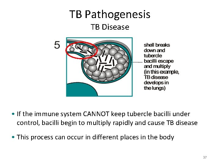 TB Pathogenesis TB Disease • If the immune system CANNOT keep tubercle bacilli under